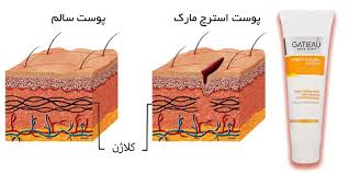 کرم رفع ترک های پوستی ناشی از بارداری و چاقی و لاغری گاتیو ایتالیا 100 میل
